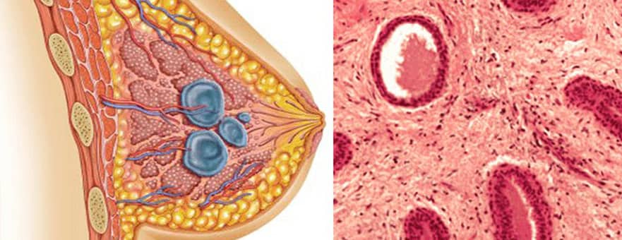 Fibroadenom Nedir? Fibroadenom Nedir?