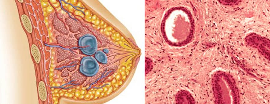 Fibroadenom Nedir?